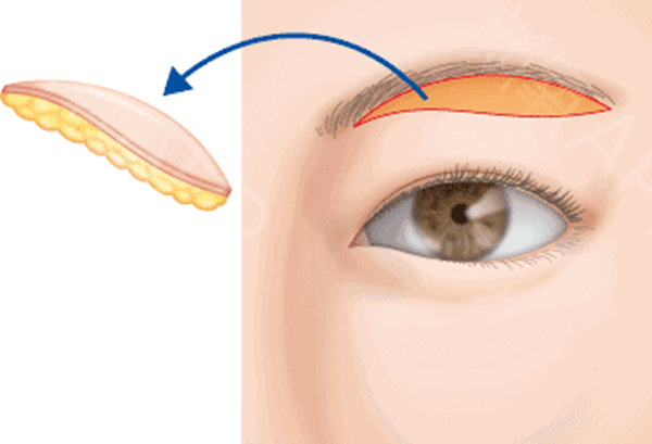 真相:提眉手术有风险和后遗症吗、提眉手术风险大吗